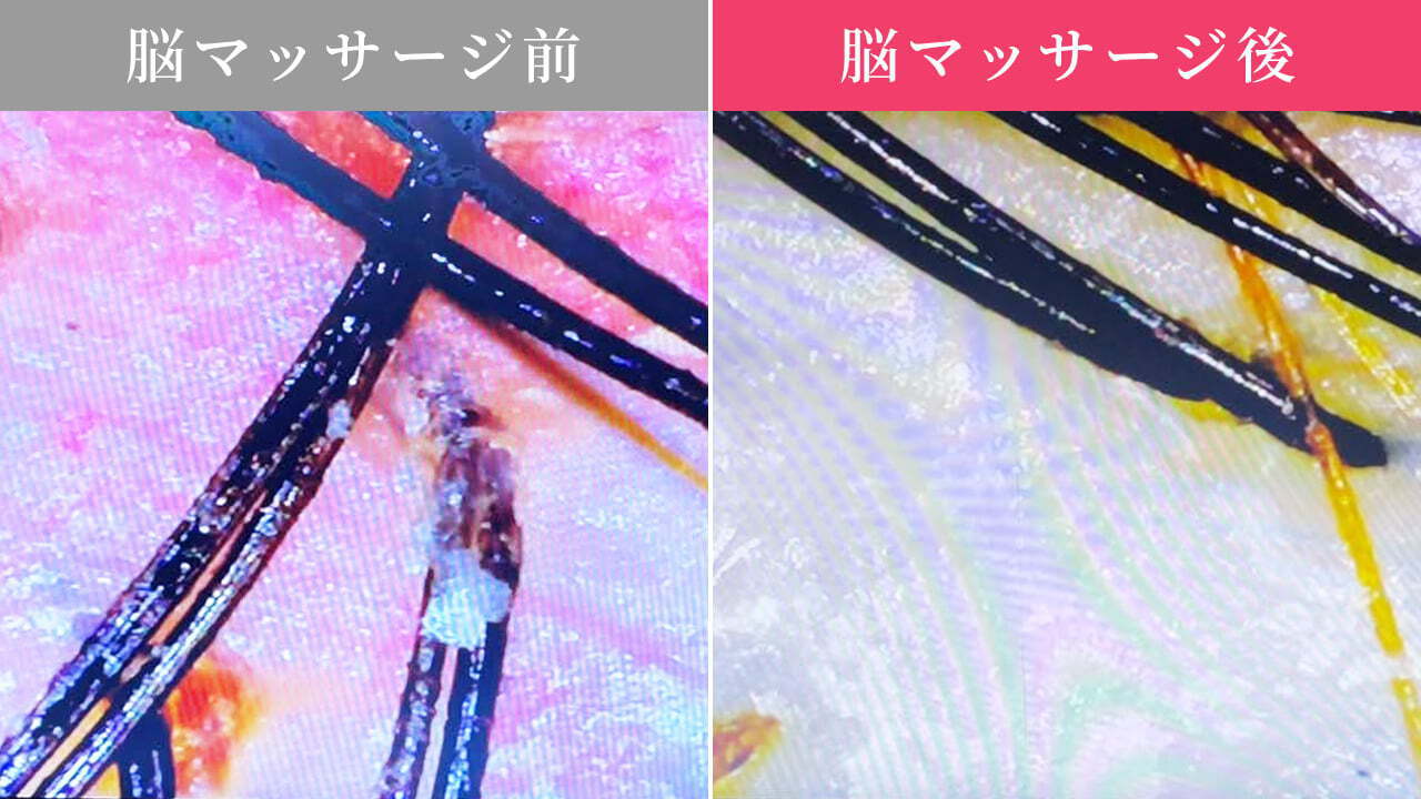 脳マッサージ前後の頭皮の変化